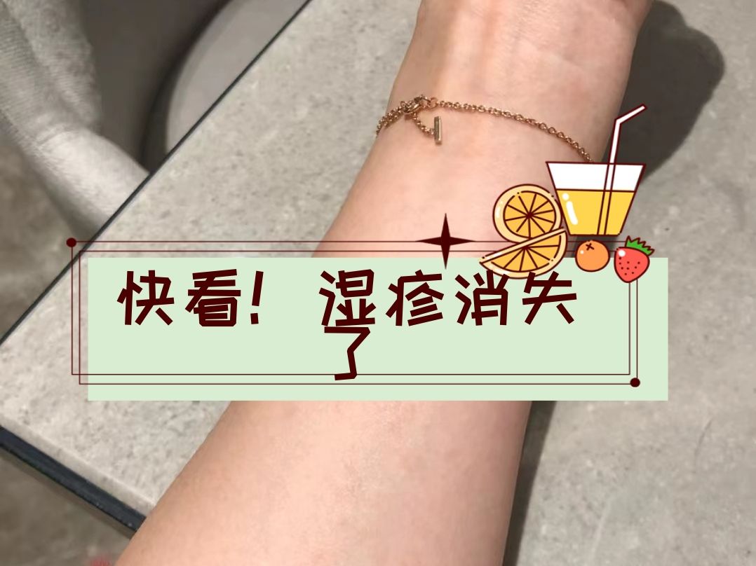 这个超简单低成本去湿疹攻略!赶紧收藏!