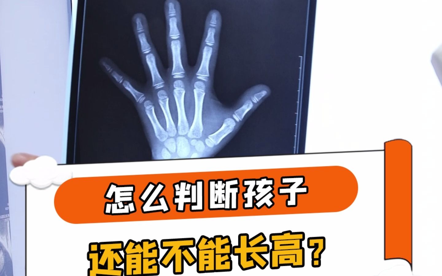 如果骨骺线闭合了,就啥子办法都没有了.