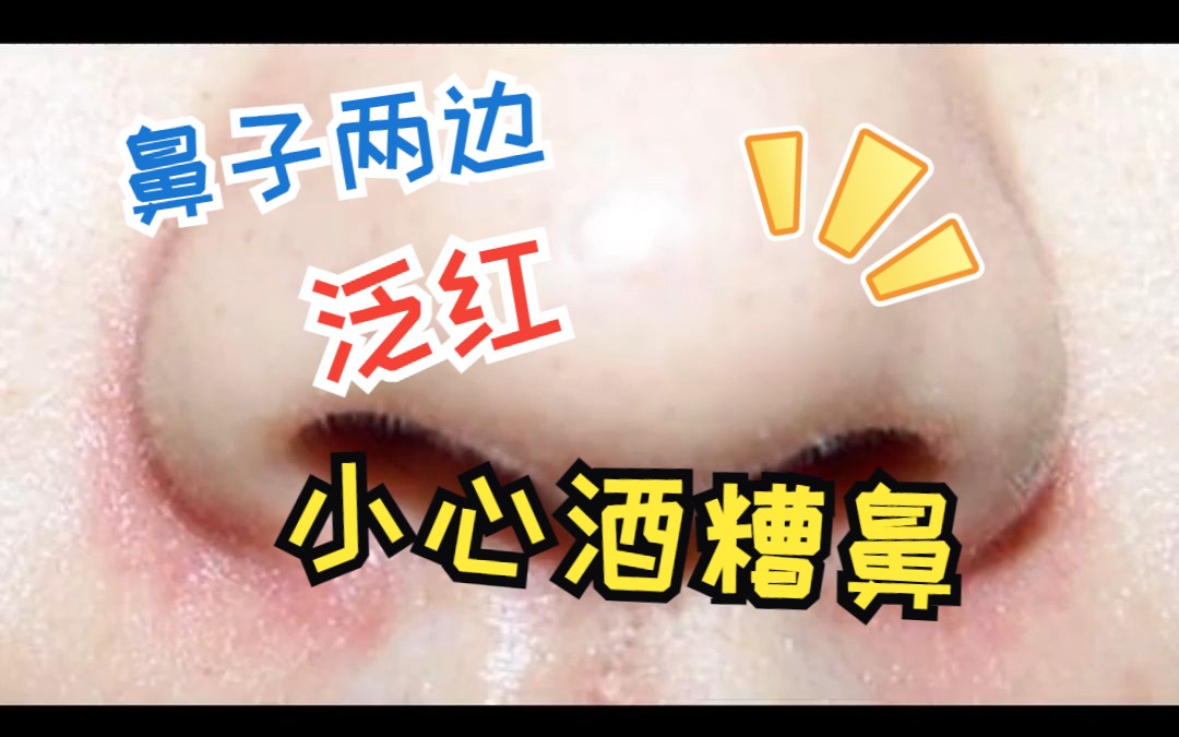 鼻翼两边泛红、油腻,小心是酒糟鼻哔哩哔哩bilibili