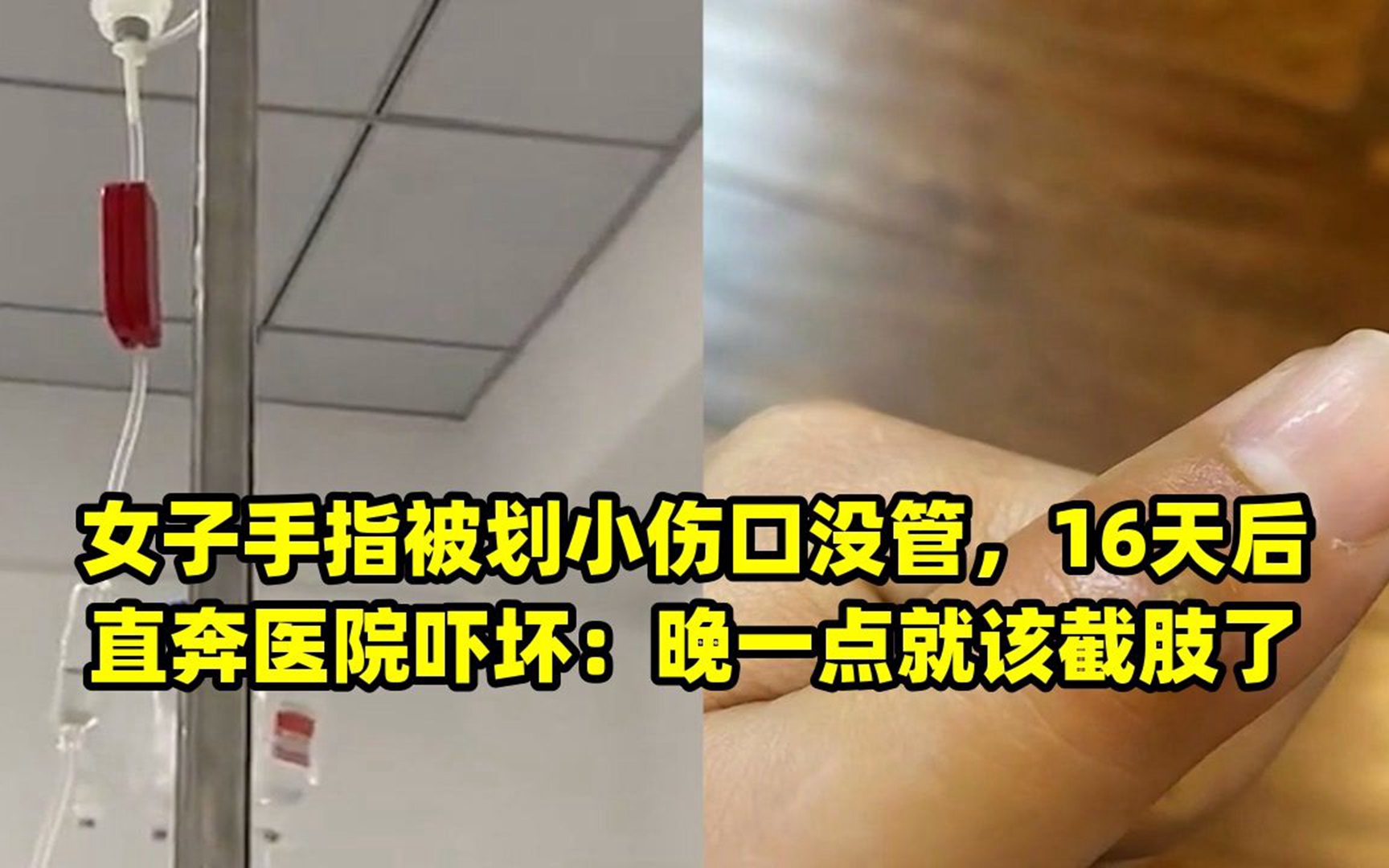 女子手指被划小伤口没管,16天后直奔医院吓坏:晚一点就该截肢了哔哩哔哩bilibili