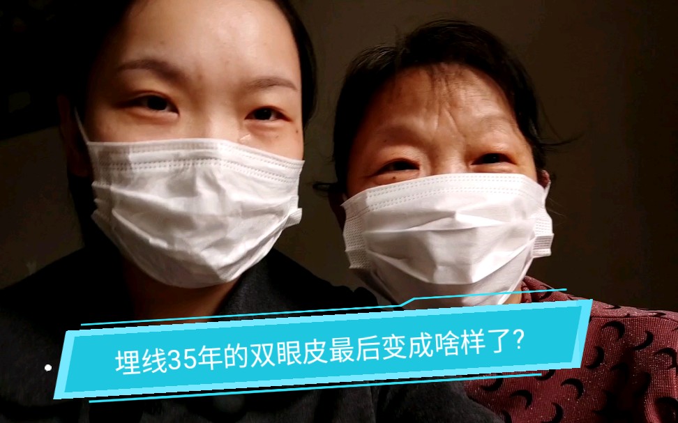 埋线双眼皮35年后双眼皮变成啥样了?最后是不是都断掉了?让60岁的嘛嘛给大家讲讲哔哩哔哩bilibili