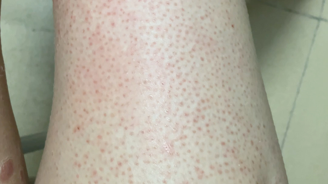 多年大腿小腿鸡皮去除记录_哔哩哔哩_bilibili