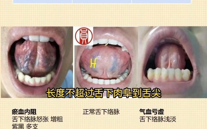 [图]舌诊系列第11讲，舌下络脉的意义