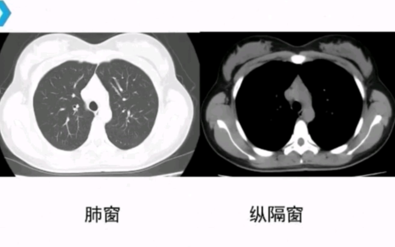 [图]胸部CT断层解剖详解。