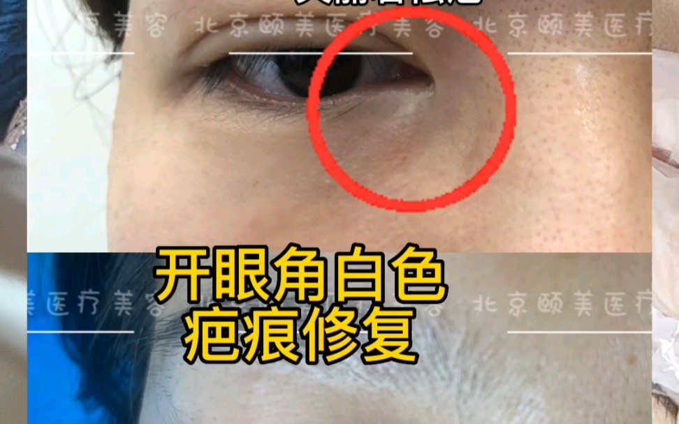 开眼角白色疤痕修复,艾四次好了很多哔哩哔哩bilibili