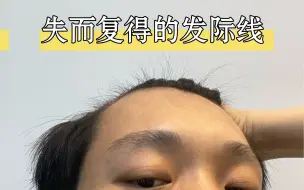 Télécharger la video: 失而复得的发际线