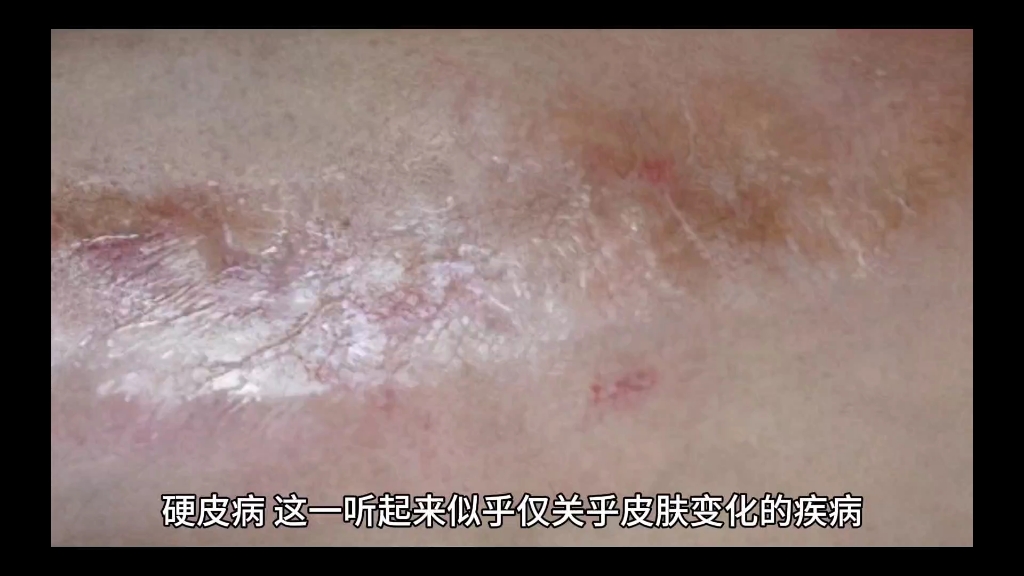 硬皮病可不只是皮肤变硬那么简单