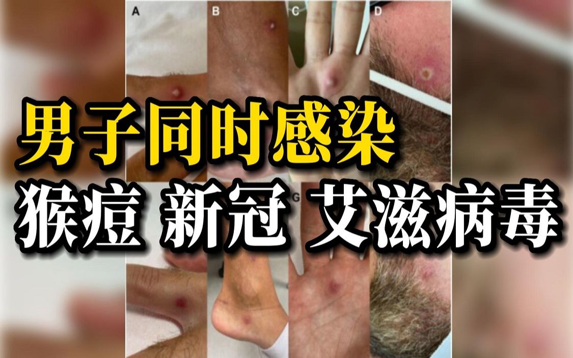 [图]全球首例！意大利男子同时感染猴痘、新冠和艾滋病毒