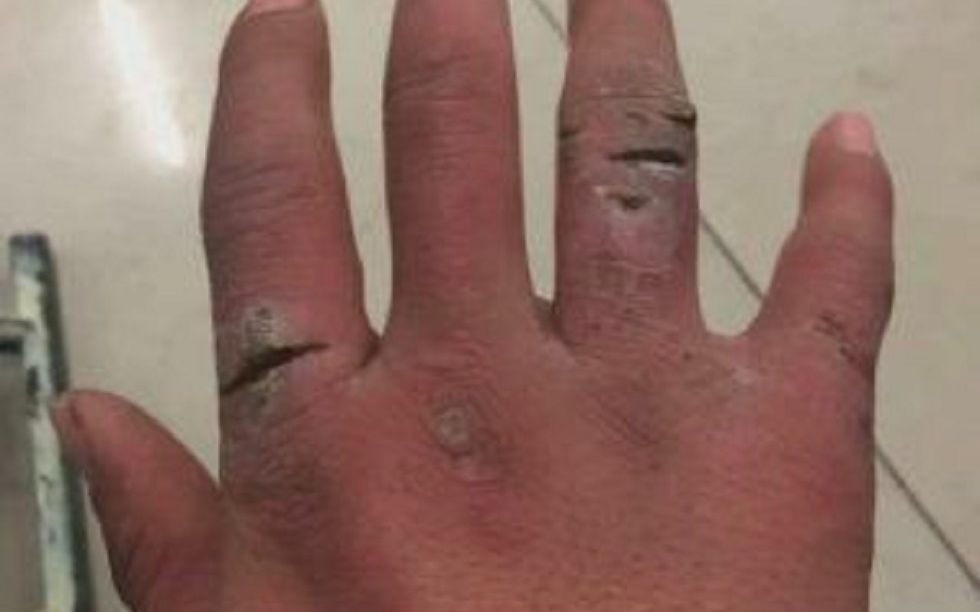 冬天被冻伤手指红肿还刺痒!每天坚持这3步,痒疼困扰不再有!