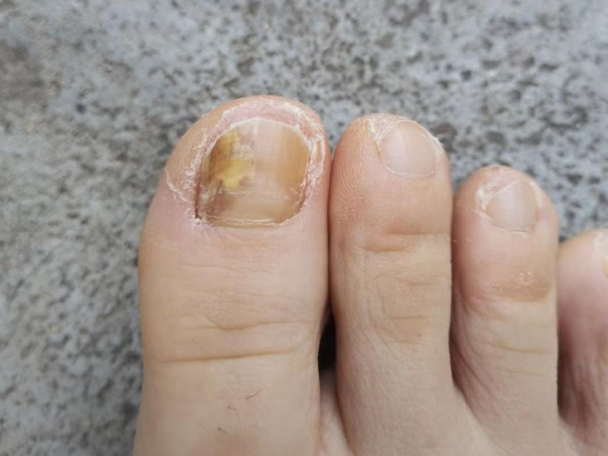 灰指甲不痛不痒不用管?别傻了!小心传染!3个方法教你解决!