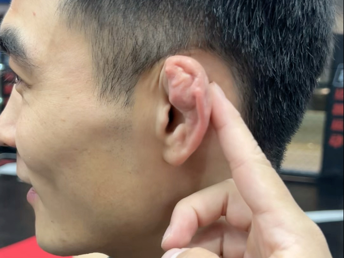 耳朵不是畸形 是摔跤形成的（俗称：饺子耳）