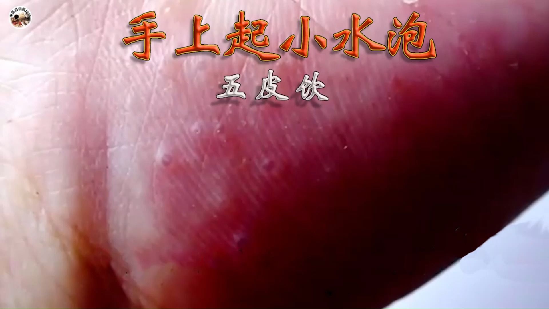 手上起小水泡