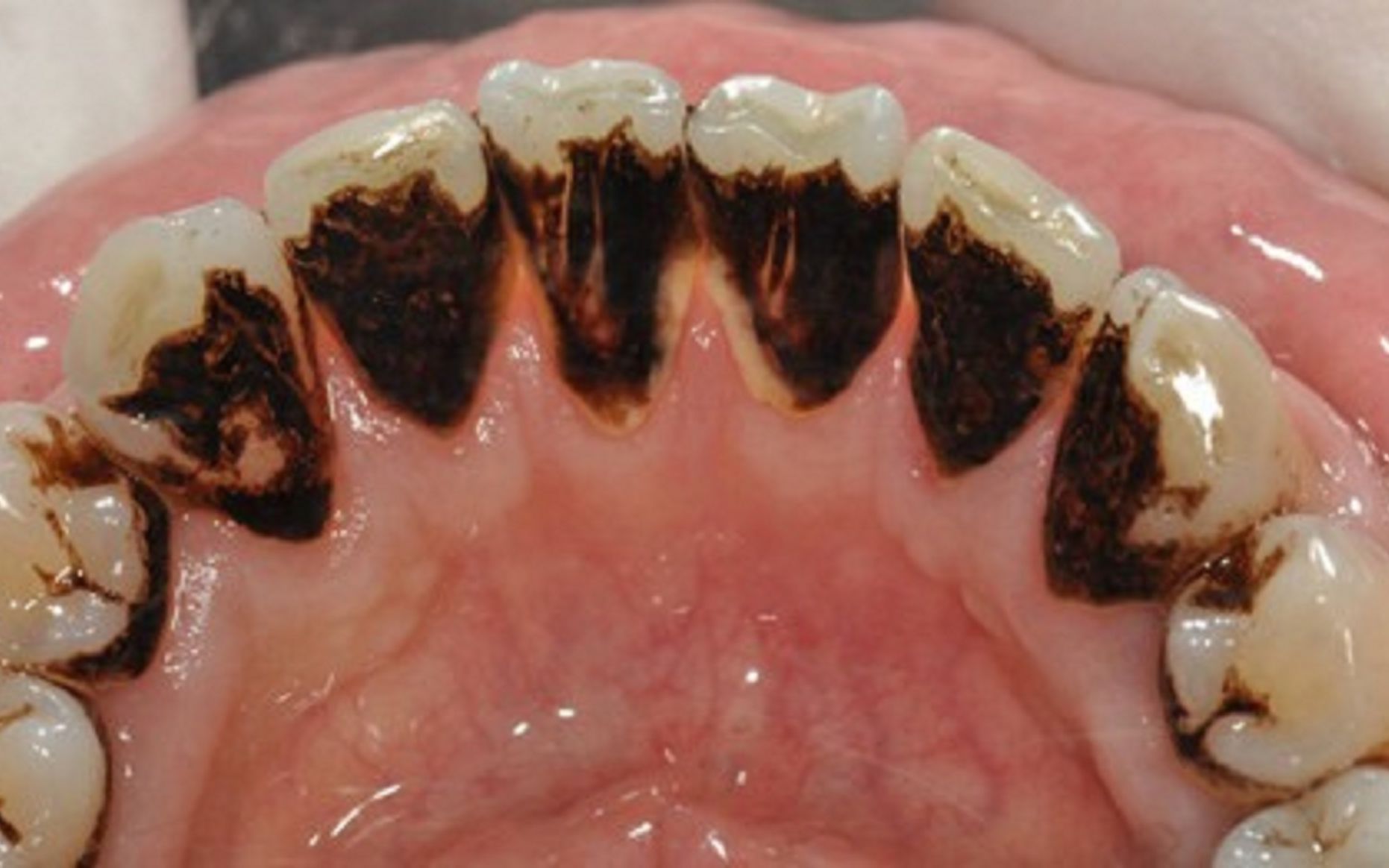 烟渍牙如何变白?学会这3个小妙招,牙齿瞬间亮白如新!