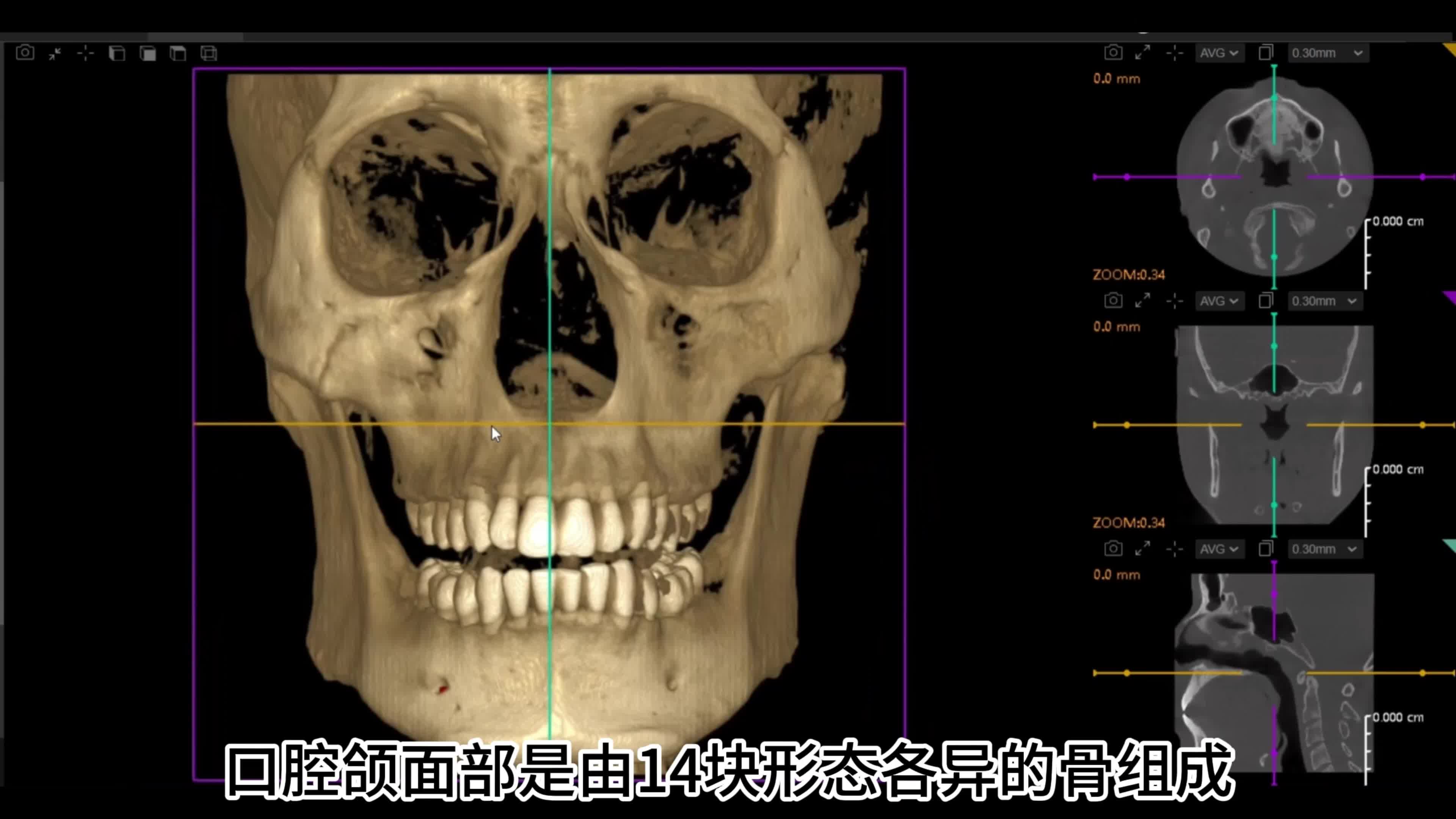 【口腔解剖】颌面部之上颌骨解剖