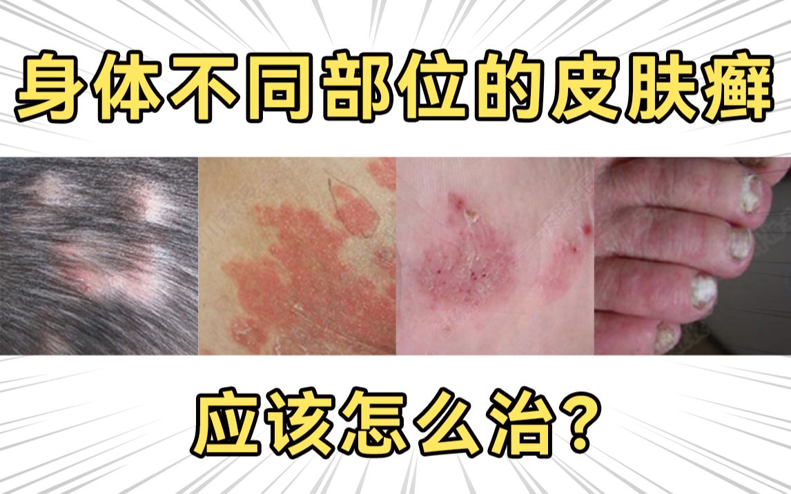 【杨希川教授】不同部位的皮肤癣怎么治?赶紧进来抄作业!哔哩哔哩bilibili