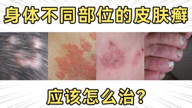 【杨希川教授】不同部位的皮肤癣怎么治？赶紧进来抄作业！