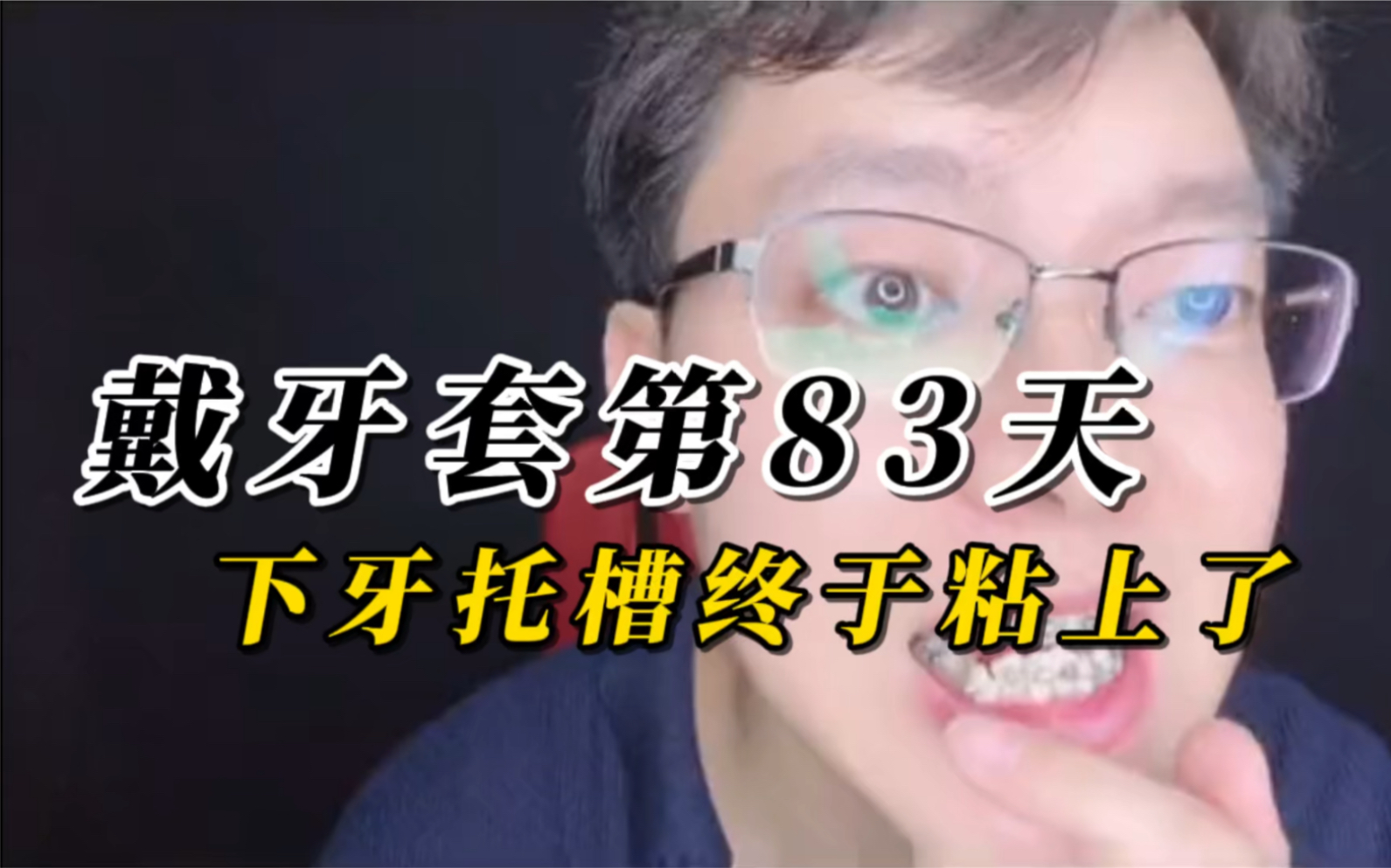 戴牙套第83天,下牙托槽终于戴上了!哔哩哔哩bilibili