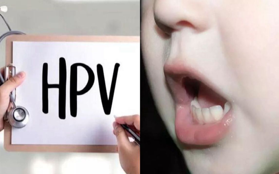 6岁男童声嘶4年,就医时查出感染hpv,声带上长出"菜花"状肿块