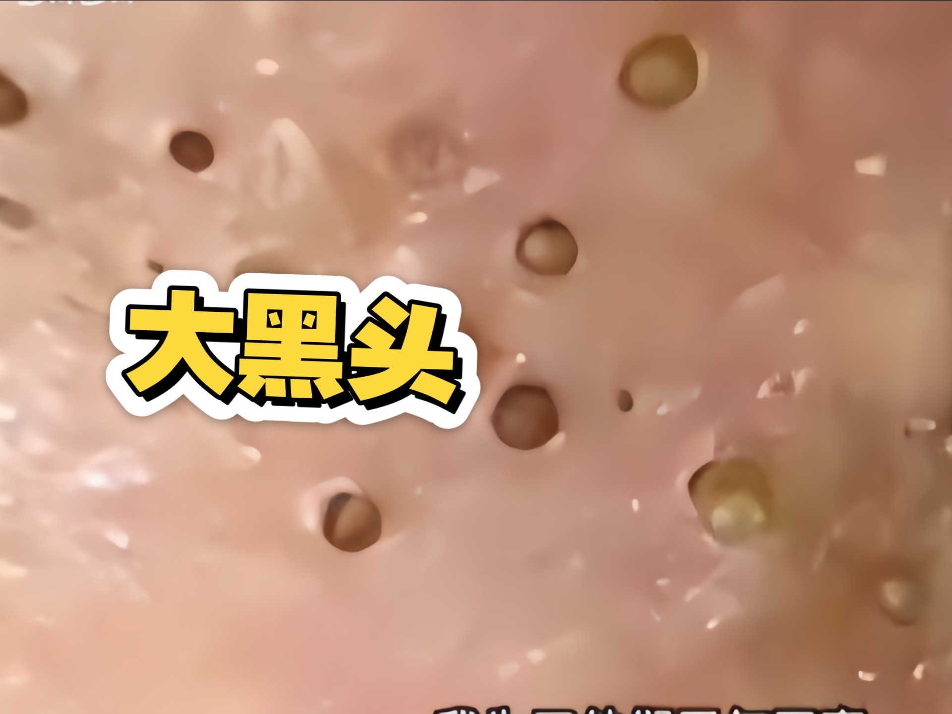 这脸还有救吗?挤痘 挤黑头天花板解压