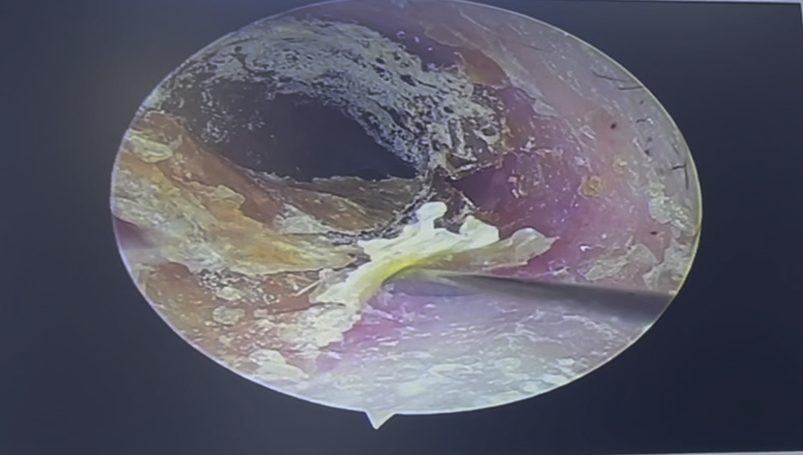耳道真菌感染耳耵聍清理,一大片整个夹出,掏掏掏