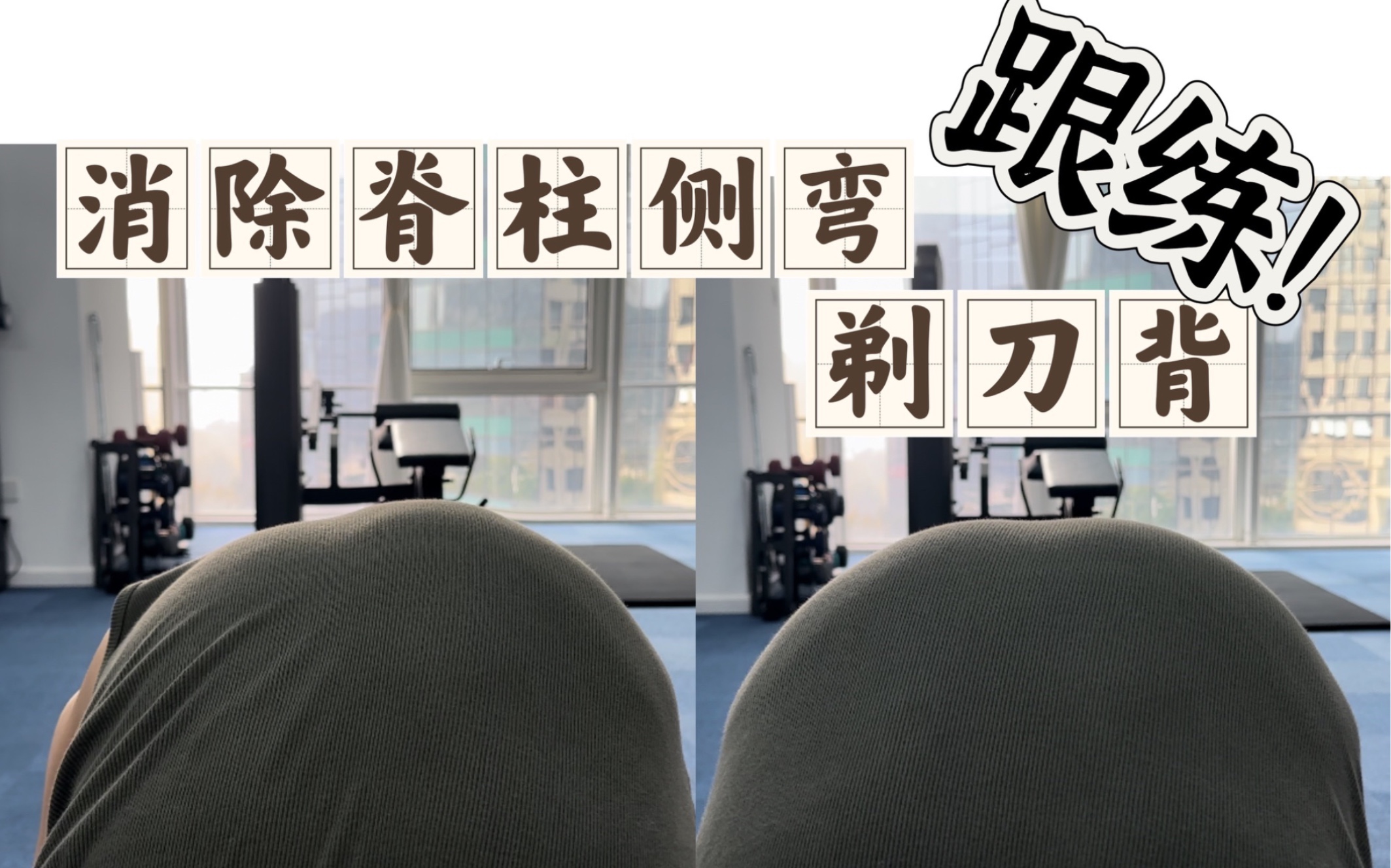 消除【脊柱侧弯】【剃刀背】,跟练版!哔哩哔哩bilibili