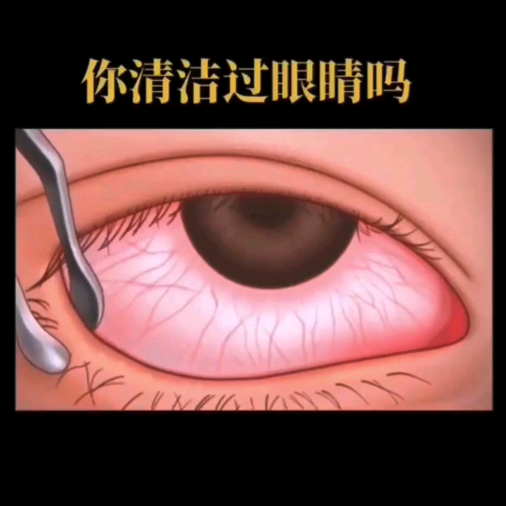 睑板腺按摩 眼部清洁疏通腺管哔哩哔哩bilibili