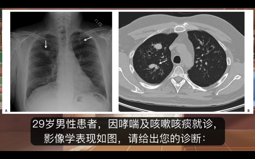 29岁男性患者,反复哮喘伴咳嗽咳痰,有没有可能是真菌感染?哔哩哔哩bilibili