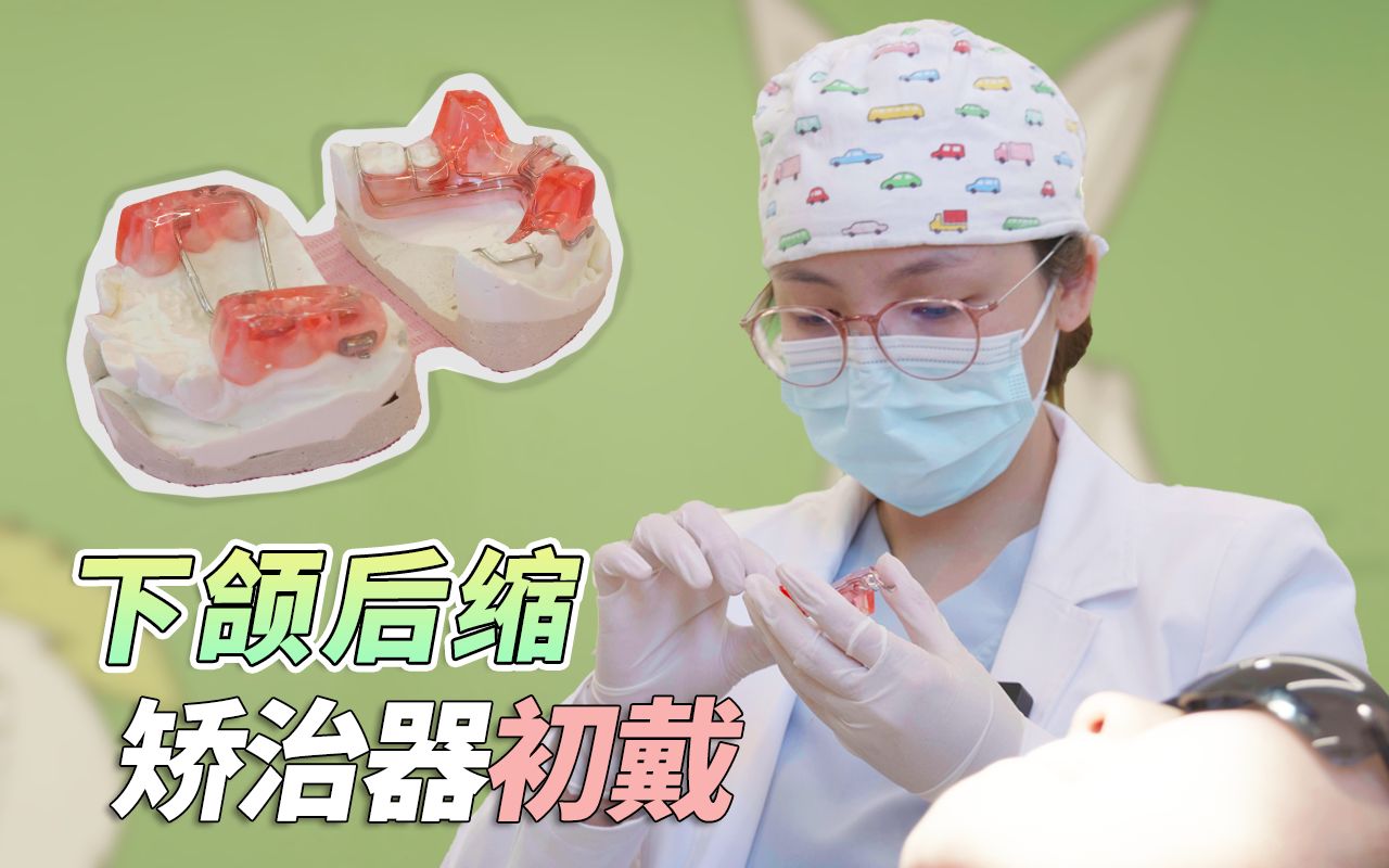 儿童下颌后缩没下巴,sgtb 牙套,双期矫治拥有精致面型