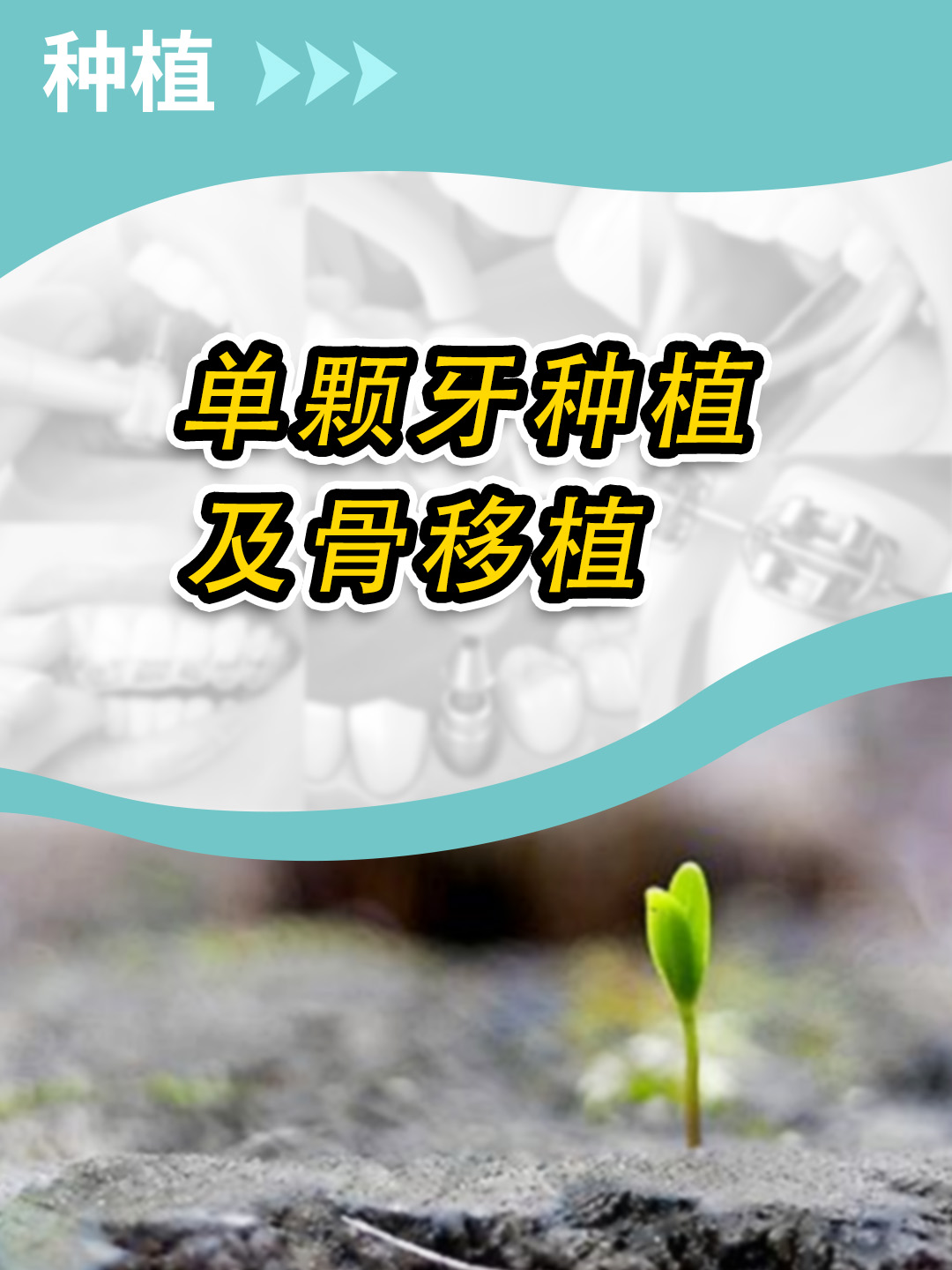 麦芽口腔|单颗牙种植及骨移植哔哩哔哩bilibili