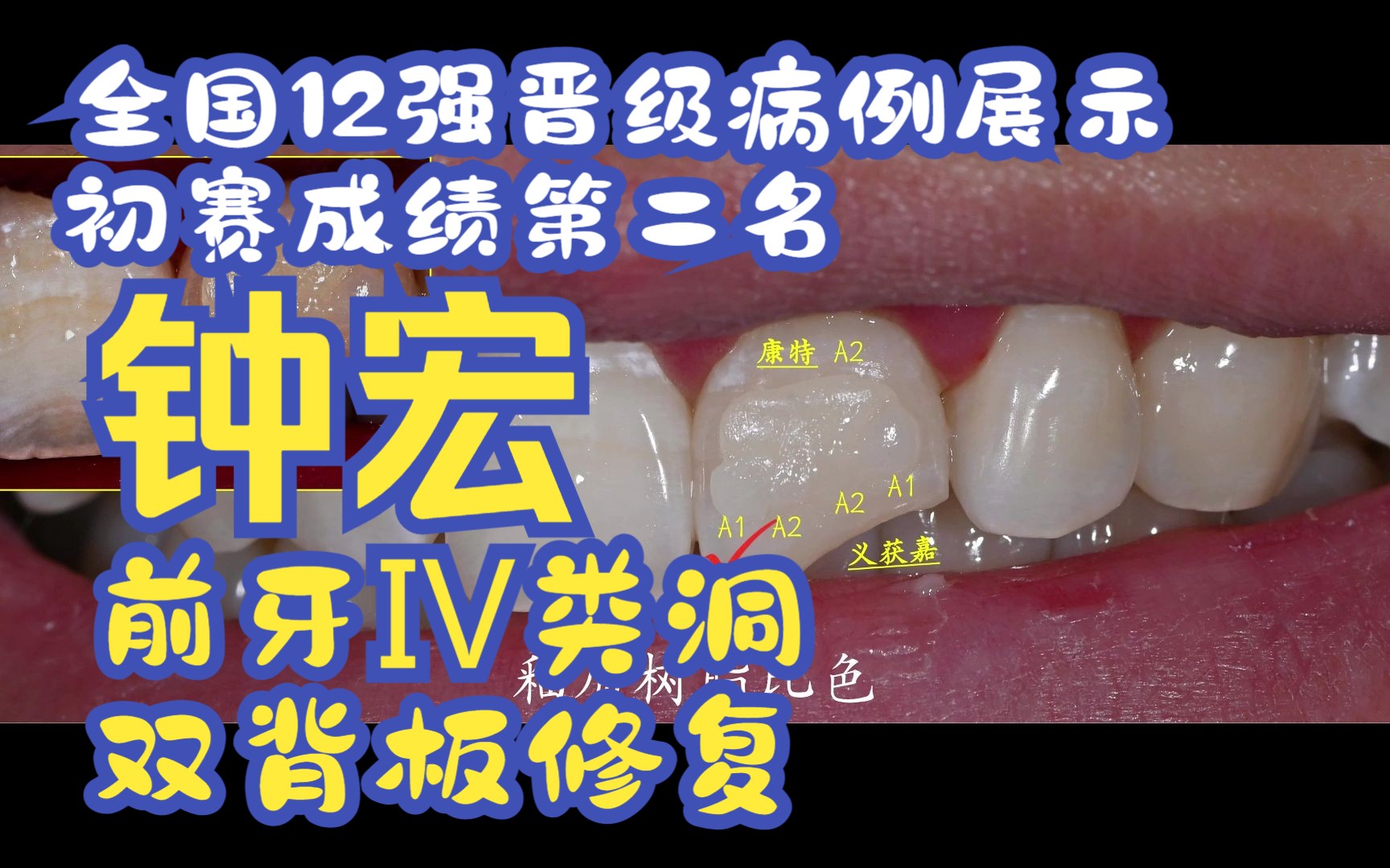 【全国决赛12强病例展示初赛成绩第二名 钟宏内外兼修重塑天然牙之美Ⅳ类洞双背板树脂成型简化分层】图片病例部分哔哩哔哩bilibili