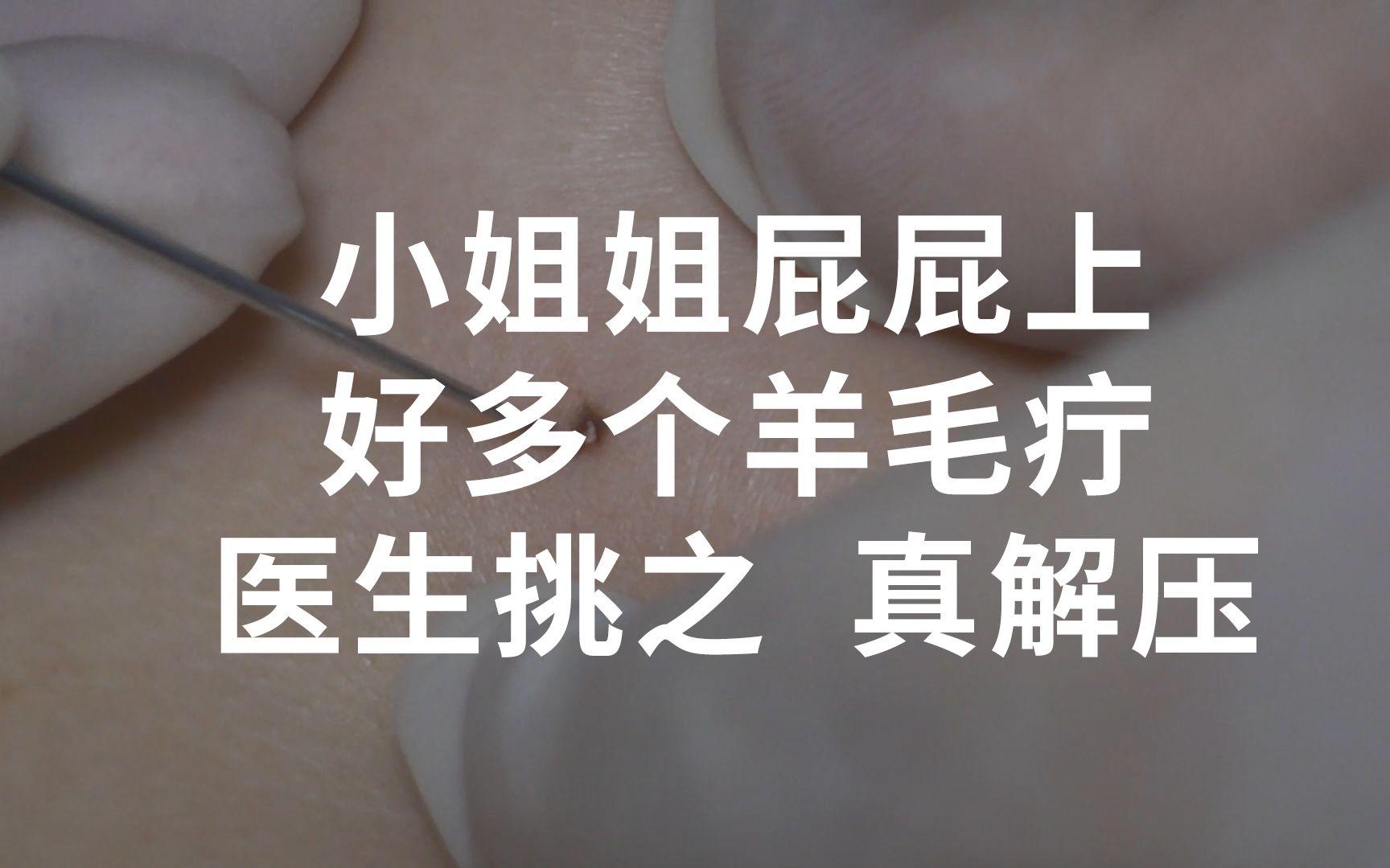 小姐姐屁屁上长了好多个羊毛疔,医生挑之,真解压-很黄很上进-租房