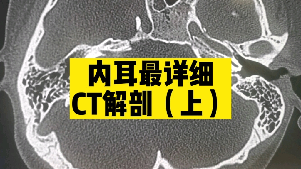 [图]【纯干货分享】内耳（耳蜗、前庭、半规管）最详细解剖！内耳畸形正确认识！