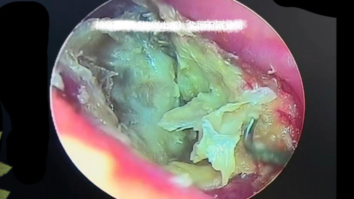 恐怖胆脂瘤、耳道被扎出一个大坑 从坑里挖出好多耳屎哔哩哔哩bilibili