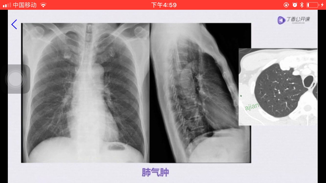 胸部x线(新完结) 第一节 胸部 X 线解剖jq哔哩哔哩bilibili