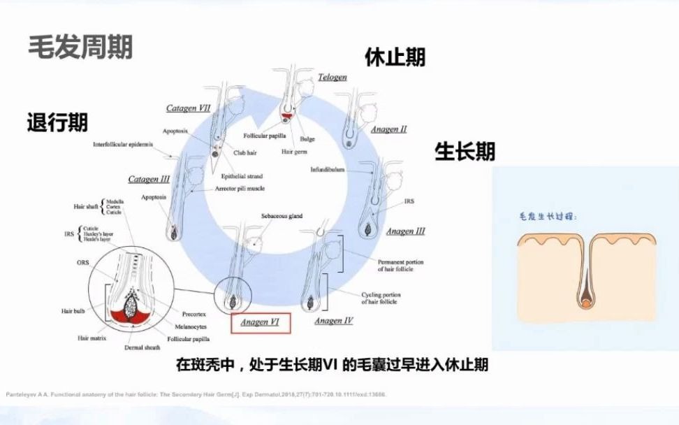 浙大一附院方红教授斑秃病因发病机制研究进展哔哩哔哩bilibili