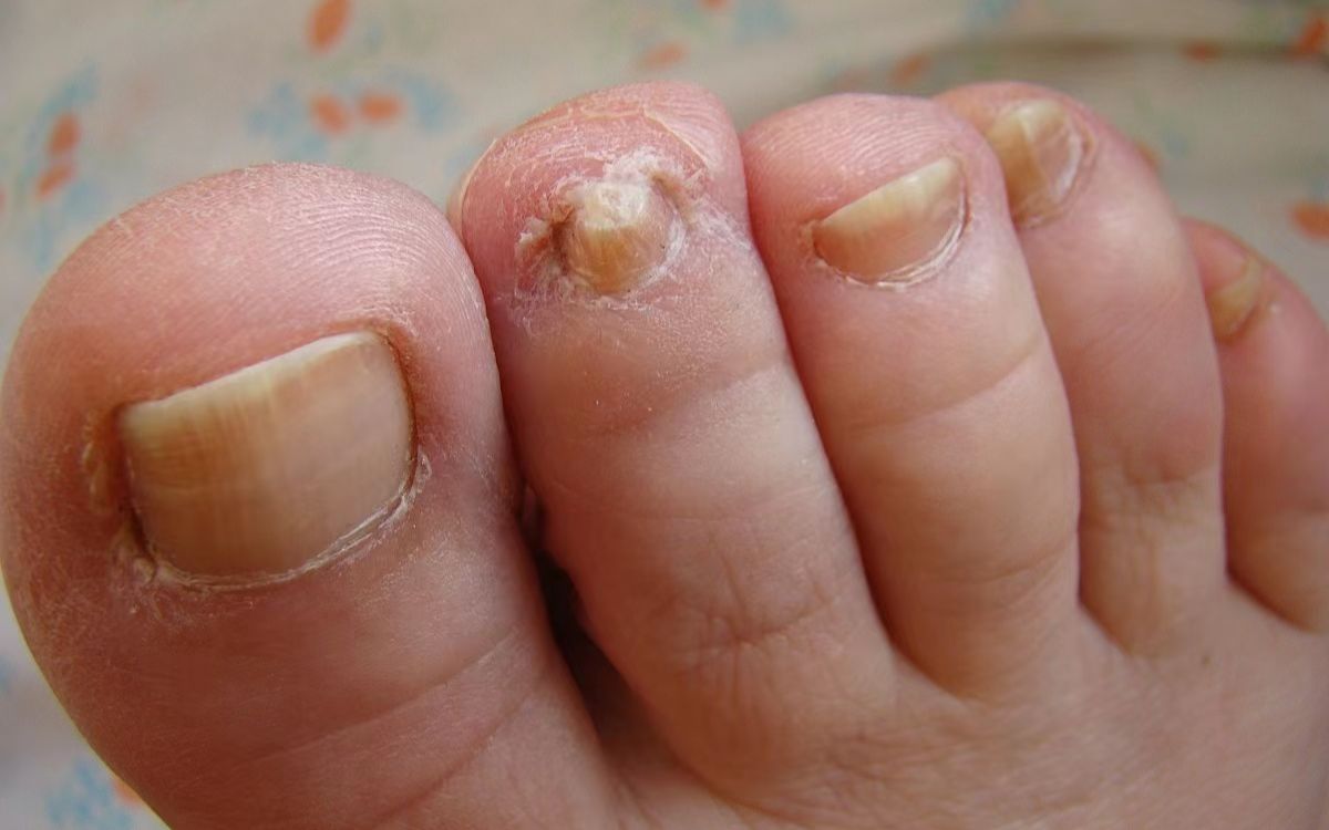 慢性灰指甲初期图片图片