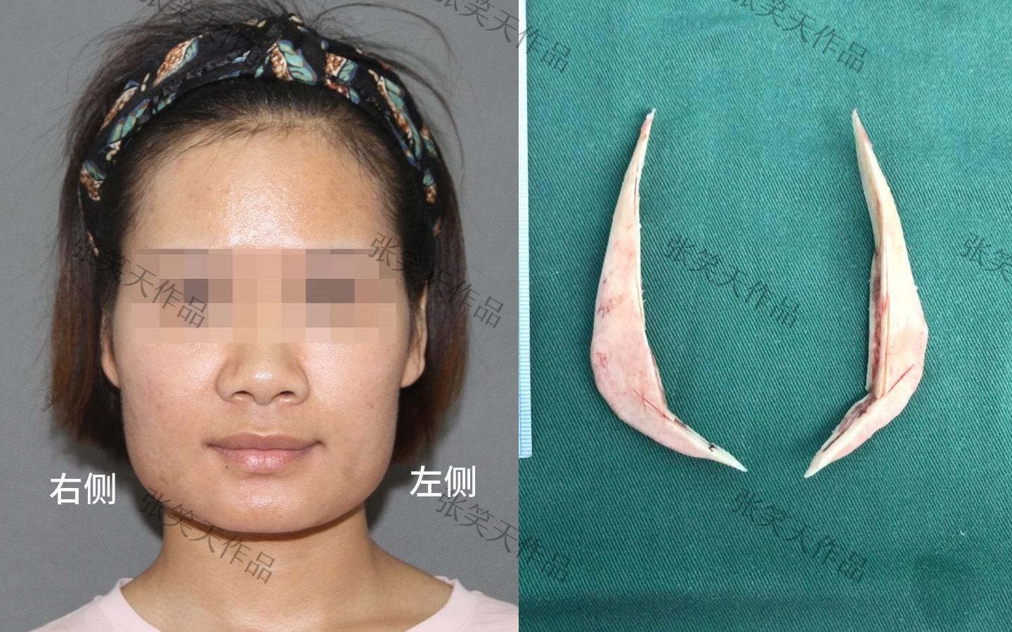 【张笑天】大小脸不对称?姑娘来做下颌角,骨骼居然这么大!