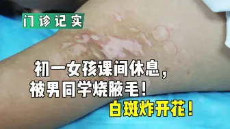 Télécharger la video: 初一女孩课间休息，被男同学烧腋毛！白斑炸开花！#白癜风