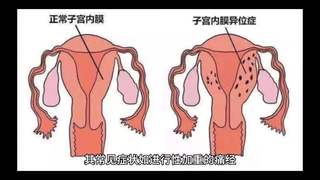 子宫内膜异位症判定方式