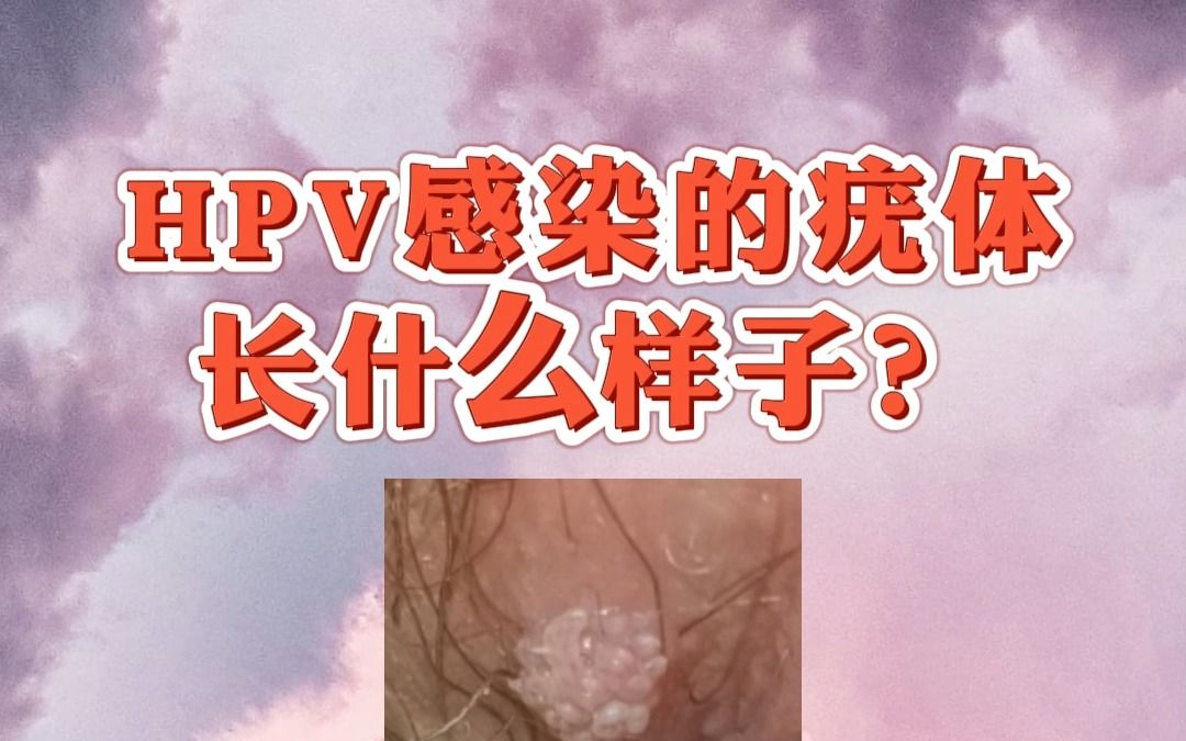 hpv是什么病尖锐湿疹图片