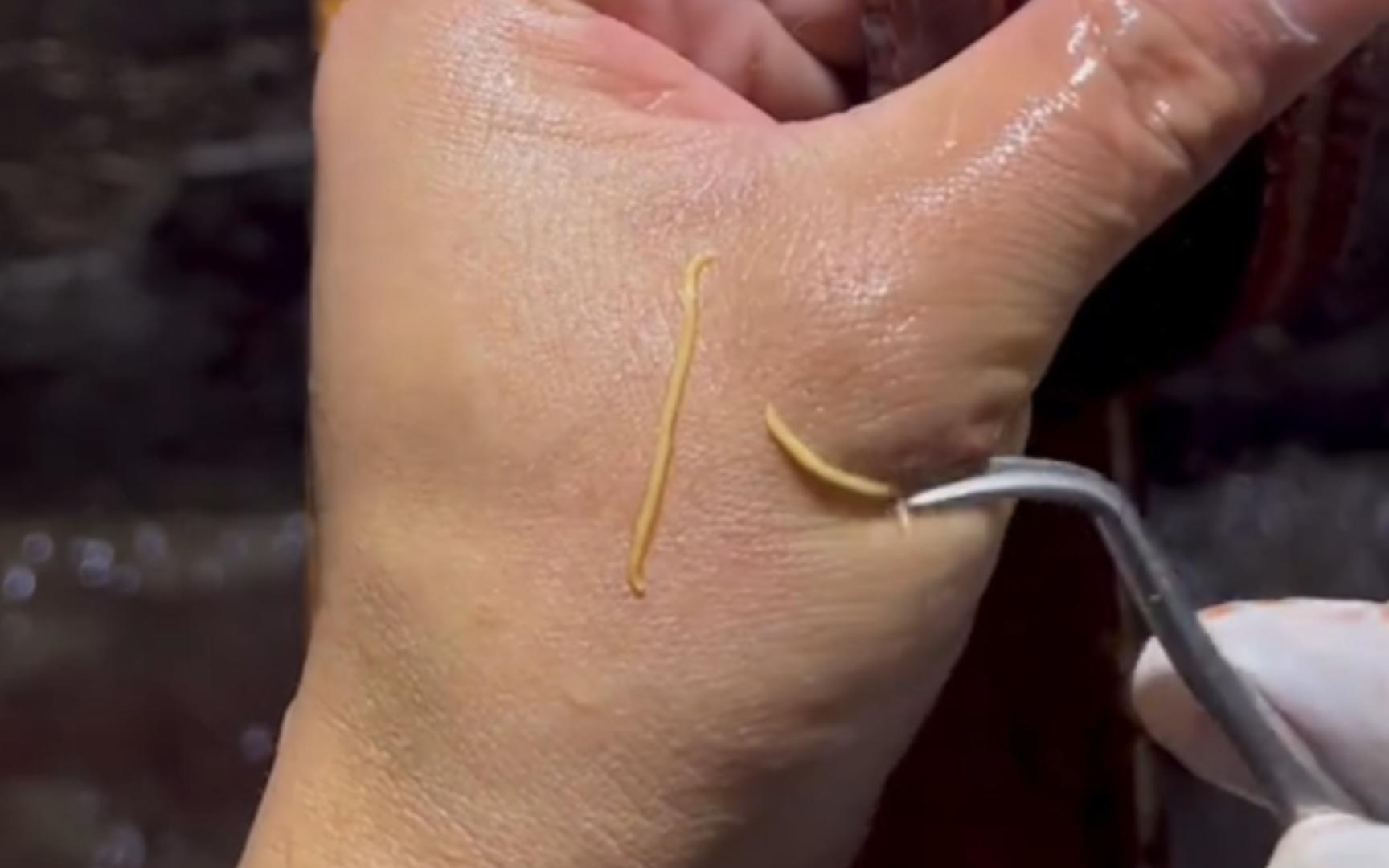 处理黄鳝,发现了黄色的寄生虫,大家吃一定做熟!