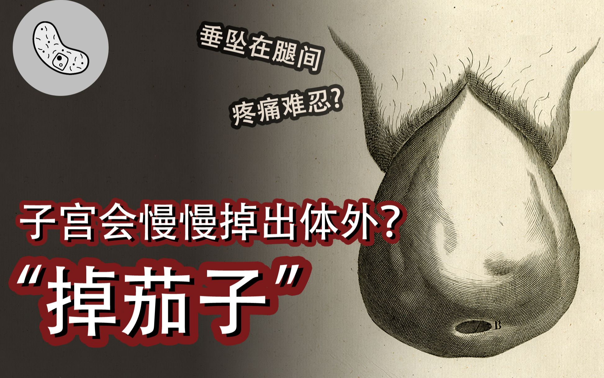 [图]【子宫脱垂】子宫会慢慢掉出体外？不生也有风险？这些雷区你踩了吗？【灰细胞】