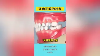 Tải video: 牙齿正畸的过程3D模拟