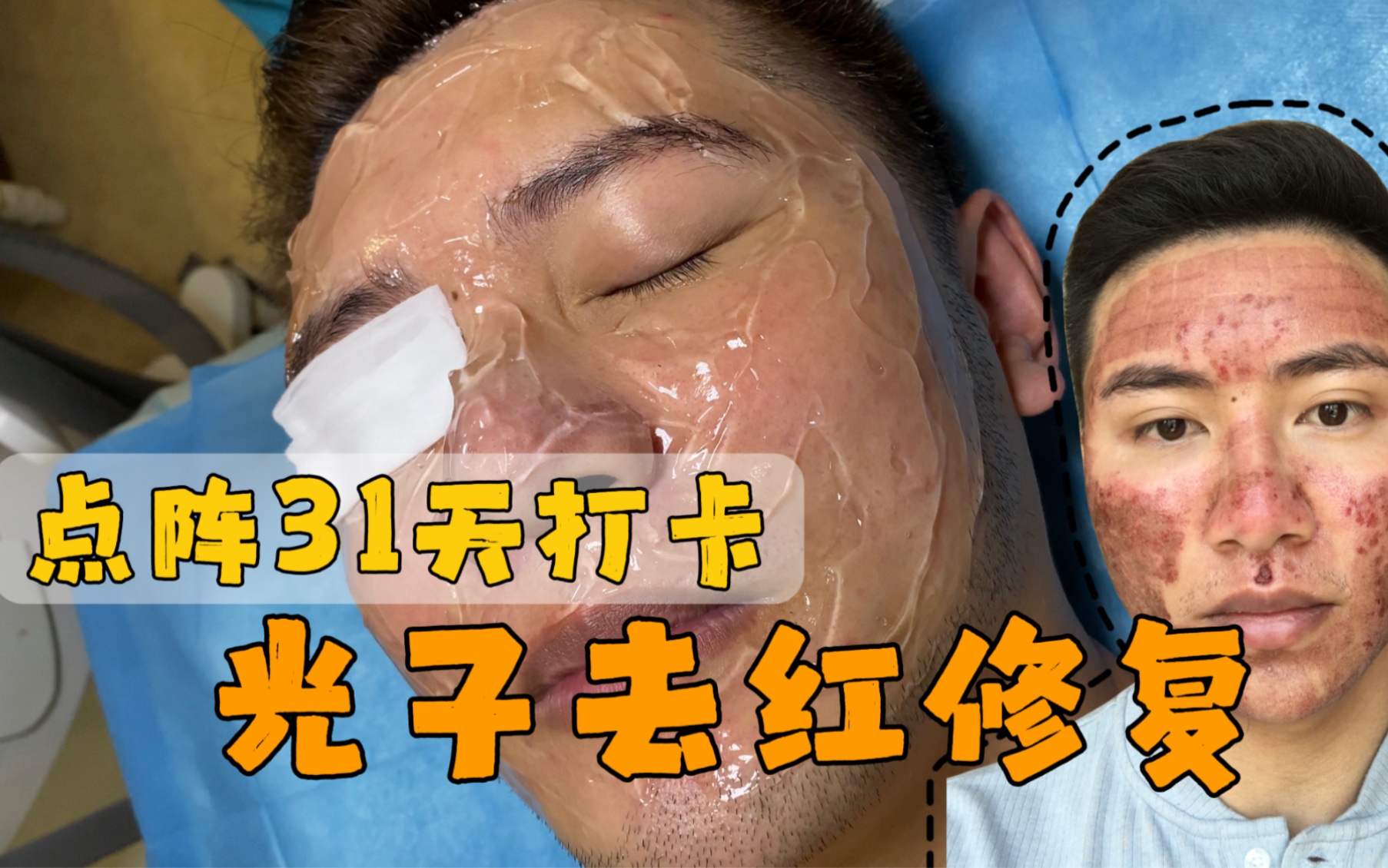 AOPT超光子退红,换三种滤波片打了20多分钟哔哩哔哩bilibili