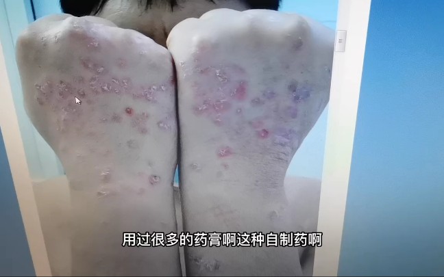 男子摸了一次癞蛤蟆,手上长满小瘤子,原以为是被癞蛤蟆感染的,一查竟然是牛皮癣!哔哩哔哩bilibili