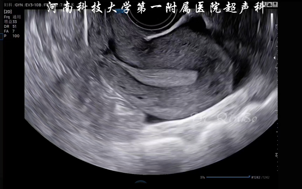 子宫局限性腺肌病哔哩哔哩bilibili