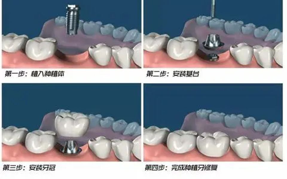 深圳种植牙科普怎样选择靠谱的种植牙医院和医生呢?哔哩哔哩bilibili