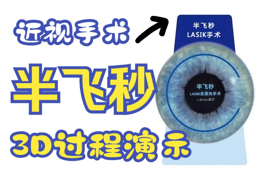 近视手术之半飞秒LASIK手术流程3D视频展示哔哩哔哩bilibili