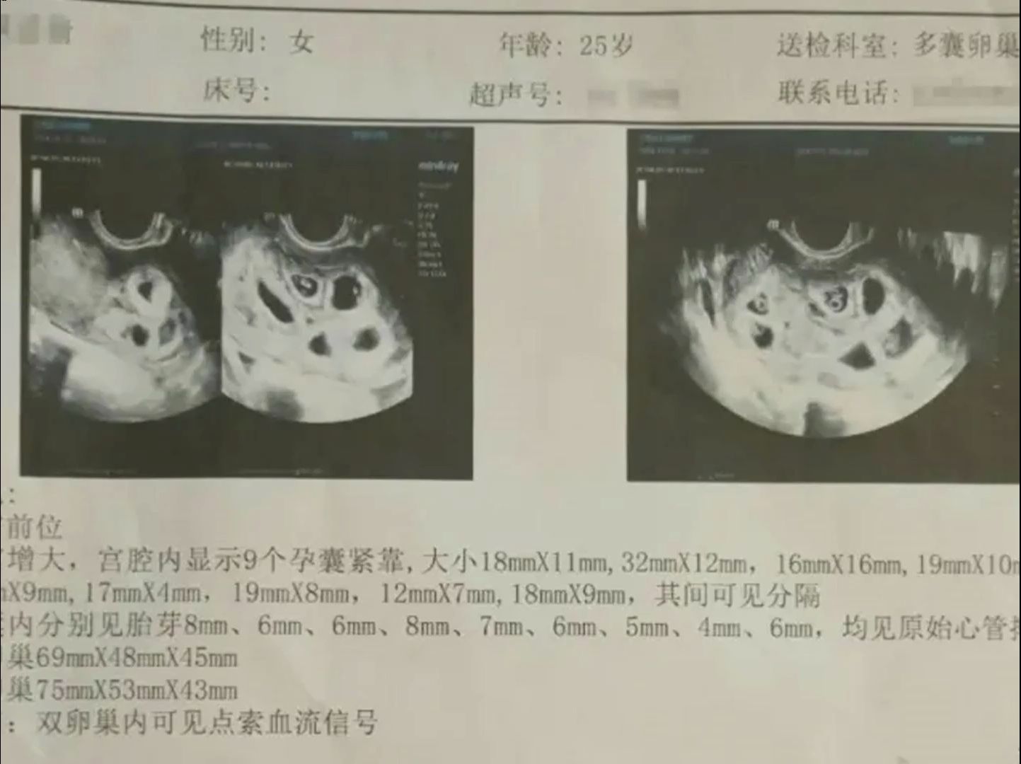 江西南昌一女子怀上9胞胎,就诊医院医生:最多保2个哔哩哔哩bilibili