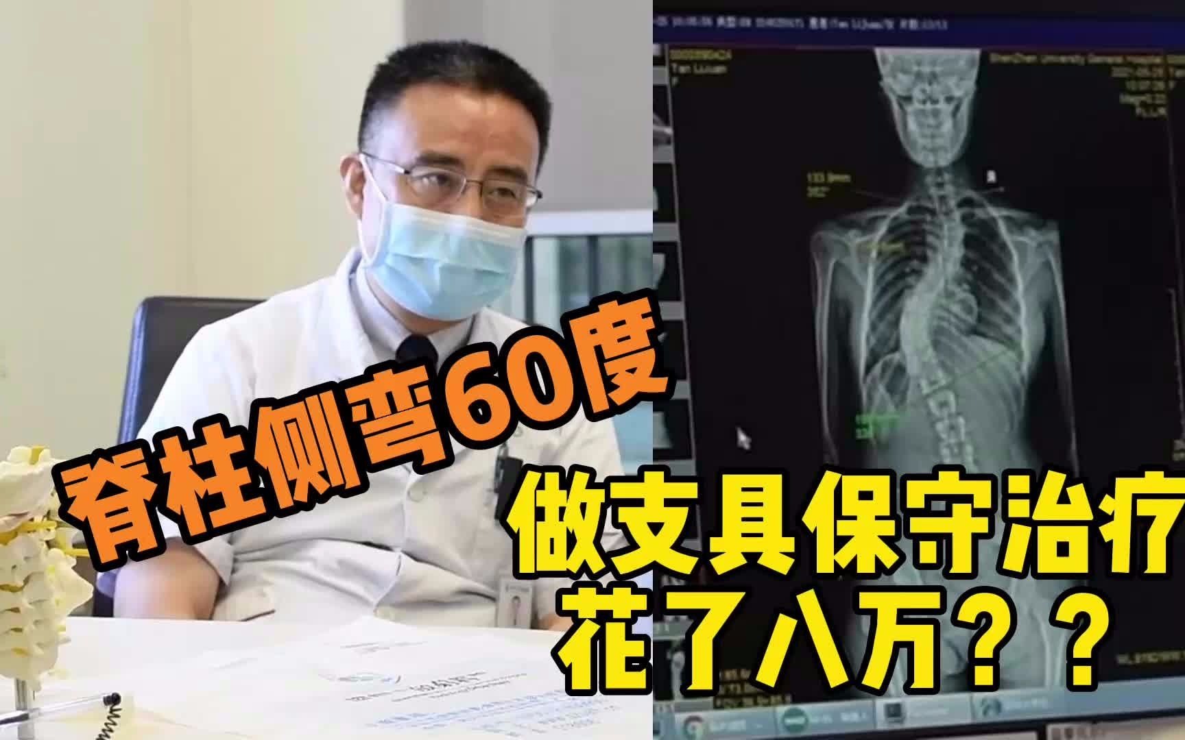 脊柱侧弯60度,做支具保守治疗花了八万,度数不降反增哔哩哔哩bilibili